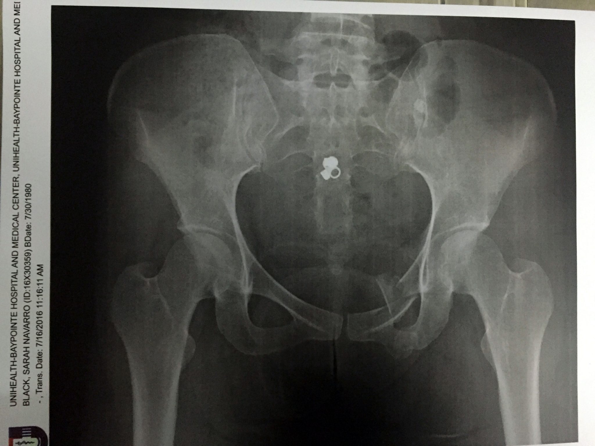 A scan of Sara Black's hip