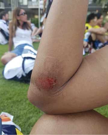 Grazes and scrapes are fondly called "tocino" by Filipino cyclists